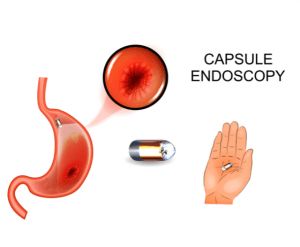 Endoscopy Explained Gastroenterologist In Cape Town Dr Deetlefs