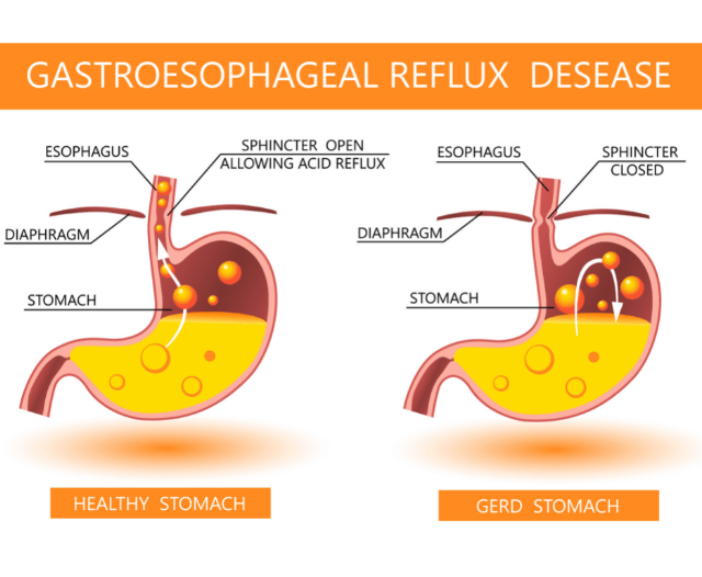 What Is GERD And How To Treat It Gastroenterologist Cape Town Gidoc