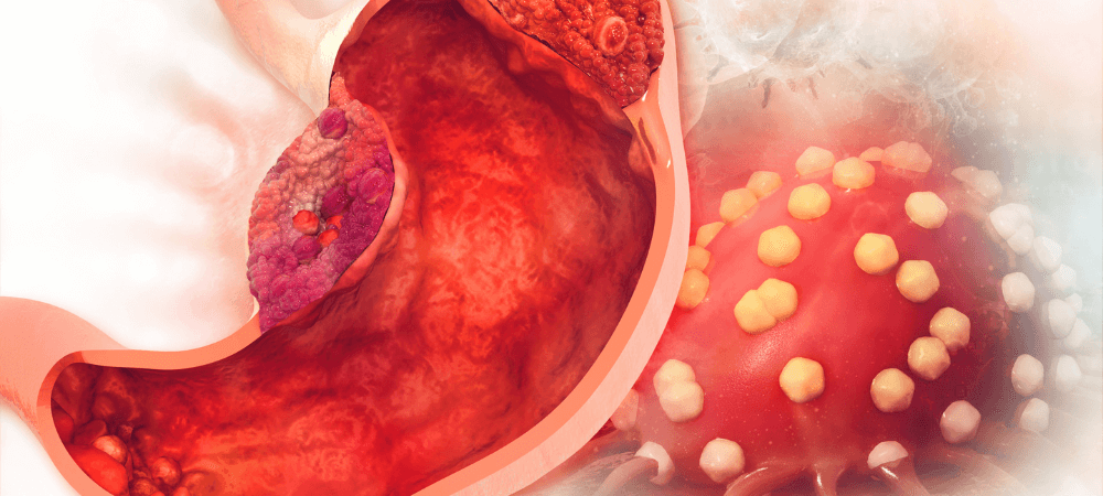 gastrointestinal_cancer