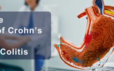 A Complete Overview of Crohn’s Disease and Ulcerative Colitis