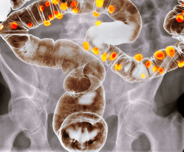 endoscopic_stent_diverticulitis