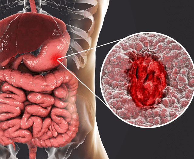 ibd_crohns_disease