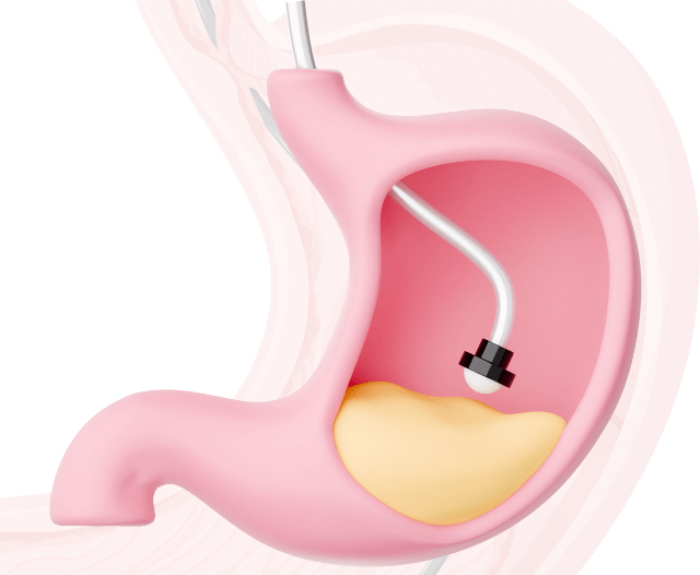 ercp_procedure_biliary_gallstones