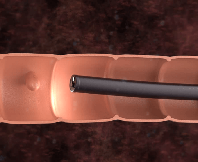 ercp_procedure_recovery