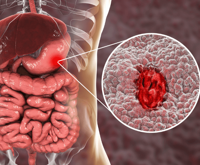 abdominal_pain_causes