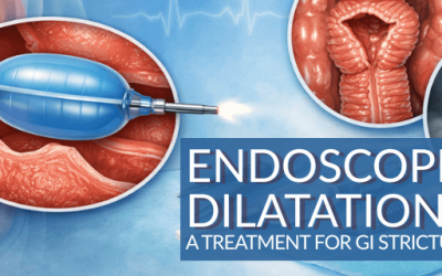 What Is Endoscopic Dilatation? A Treatment for GI Strictures Explained