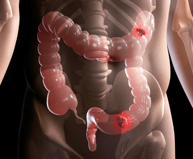 Cancer_screening_colonoscopy