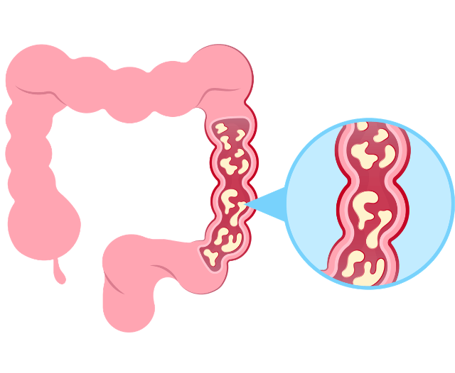 crohns_disease_monitoring