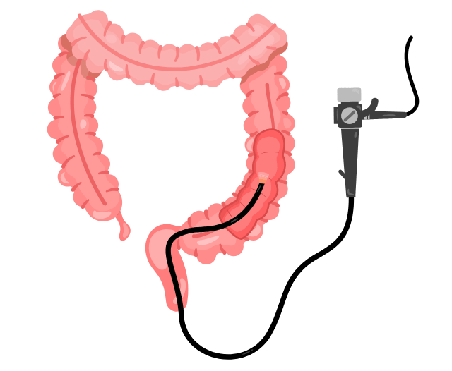 endoscopy_crohns_disease
