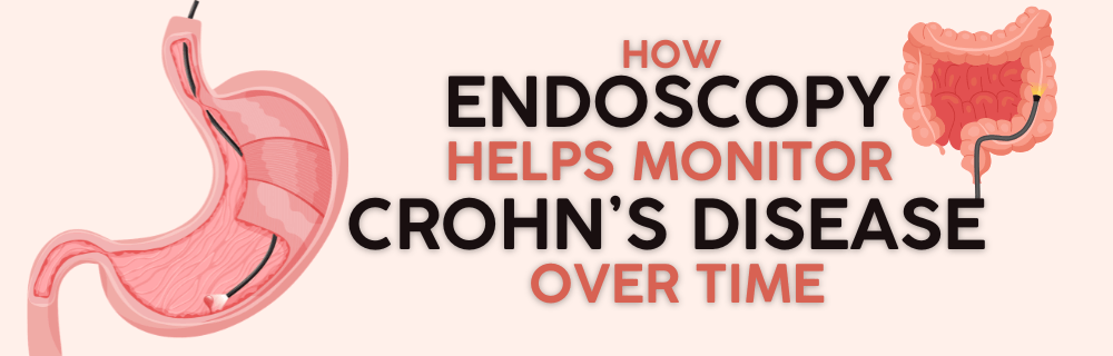 How Endoscopy Helps Monitor Crohn’s Disease Over Time