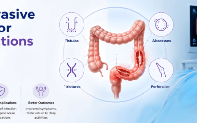 Minimally Invasive Treatments for IBD Complications